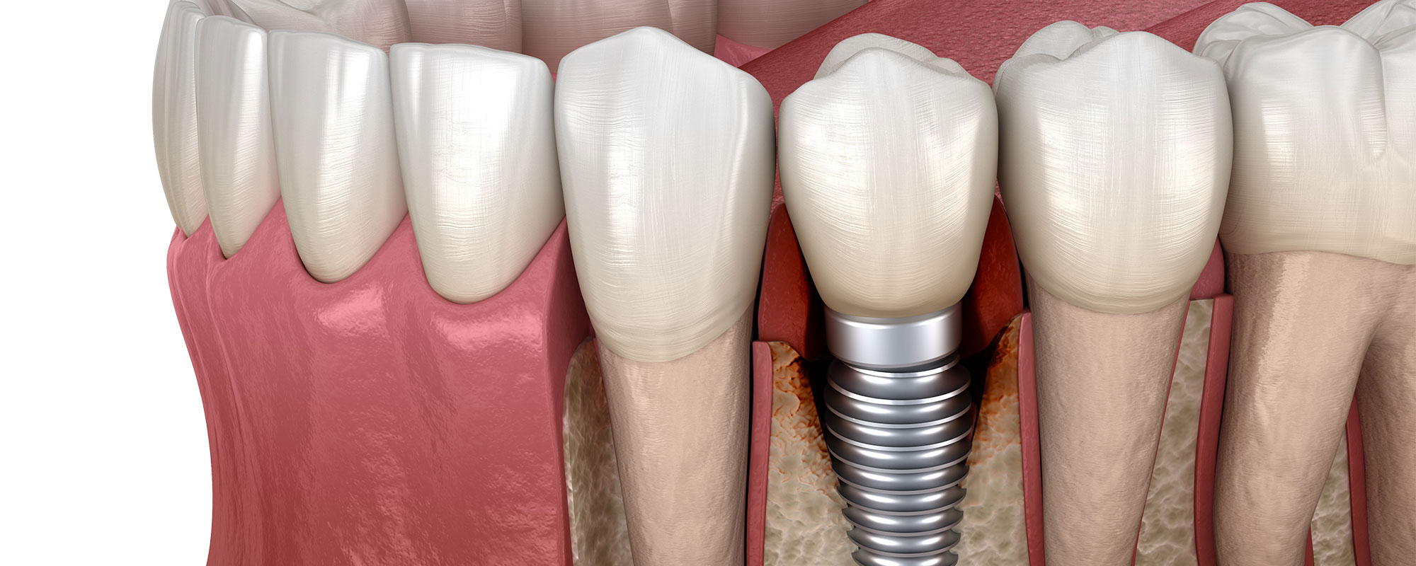 Имплант зуба заменитель