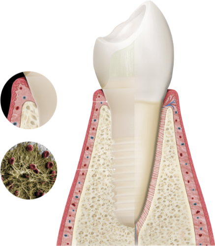 Within minutes after insertion, Patent™ Implants achieve complete Bio-Integration.