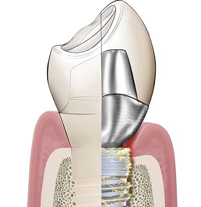 The Soft Tissue Seal of Patent™ Implants